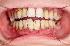 Periodontal disease is treated at Clubb Dental, Indooroopilly