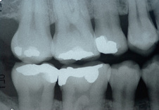 Dental Xrays are taken every 2 years at Clubb Dental