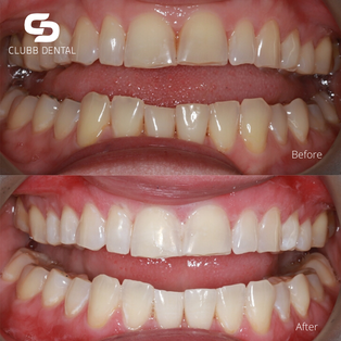 Before and After Teeth Whitening using Zoom! at Clubb Dental