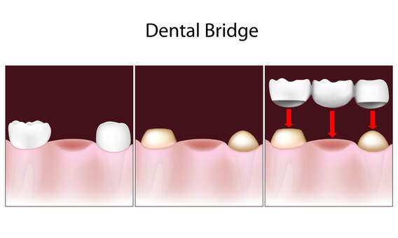 Dental Bridge at Clubb Dental