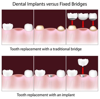 A dental Implant can be a great alternative to a Dental Bridge