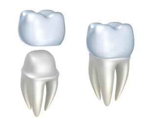 Same day dental crowns at Clubb Dental