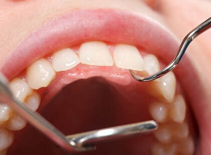 Full Mouth Dental Examination at Clubb Dental