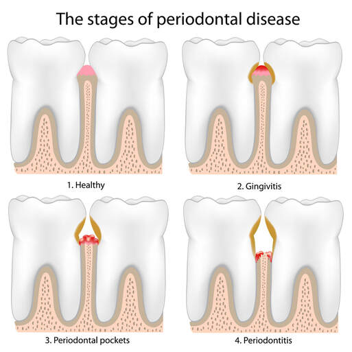 The stages of Periodontal Disease from Gingivitis to Periodontitis