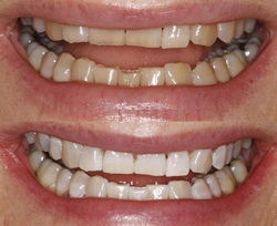 Zoom Whitening on an actual patient at Clubb Dental Chapel Hill, Brisbane