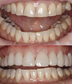 Smile Makeover of a patient at Clubb Dental Chapel Hill, Brisbane