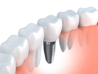 Dental Implants solve the problem of missing teeth at Clubb Dental