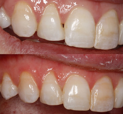 Composite Resin Bonding on an actual patient at Clubb Dental Chapel Hill, Brisbane