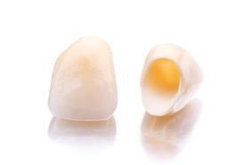 Crowns are made at Clubb Dental using CEREC technology which allows us to make the crown and fit it in a single visit