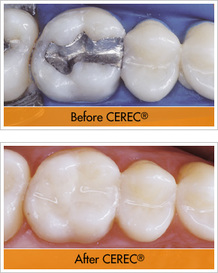 CEREC created crowns for your teeth that look better and last longer than traditional techniques.