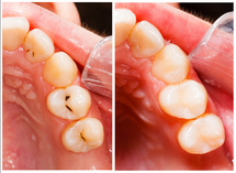 Cosmetic Bonding and Tooth Restorations at Clubb Dental Indooroopilly, Brisbane