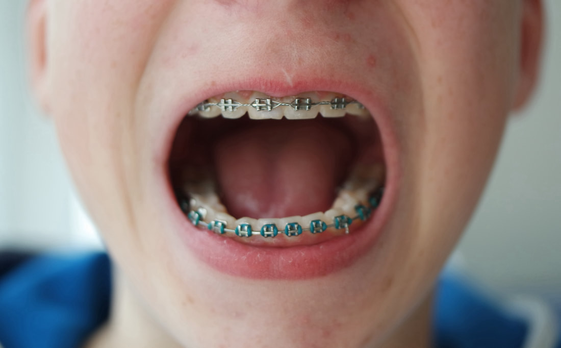 Do you still need to go to the dentist if you are seeing an Orthodontist?