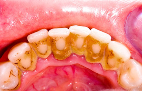Periodontitis Treated during Check Ups at Clubb Dental