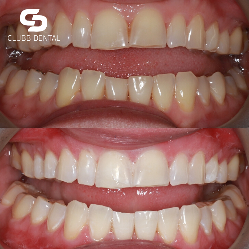 Before and After Zoom! Teeth Whitening photos from Clubb Dental