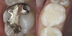 Replacing amalgam Filings at Clubb Dental Chapel Hill, Brisbane, actual patient photos