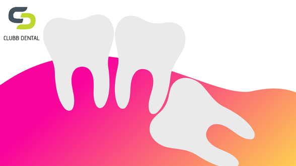 Illustration of Impacted Wisdom Teeth from Clubb Dental