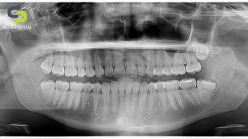 OPG x-ray at Clubb Dental