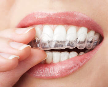 Custom made whitening trays available at Clubb Dental