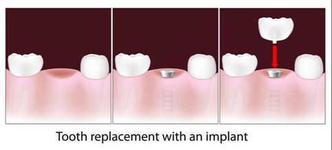 Dental Implant at Clubb Dental