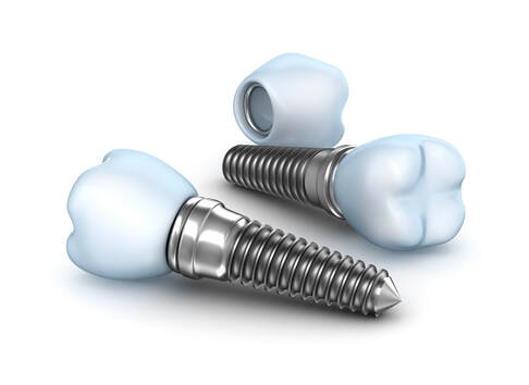 Clubb Dental Implants
