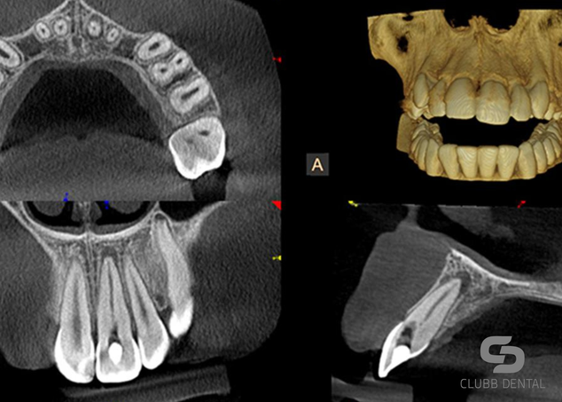 Achieving better Dental Outcomes with CBCT