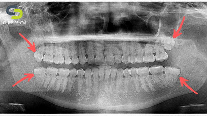 Wisdom Teeth OPG xray from Clubb Dental