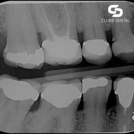 Bitewing x-rays at Clubb Dental