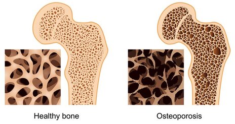Osteoporosis - bones with holes