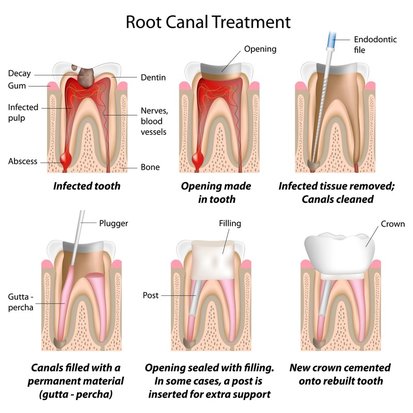 Root Canal Therapy saves teeth with infected or dead pulps.