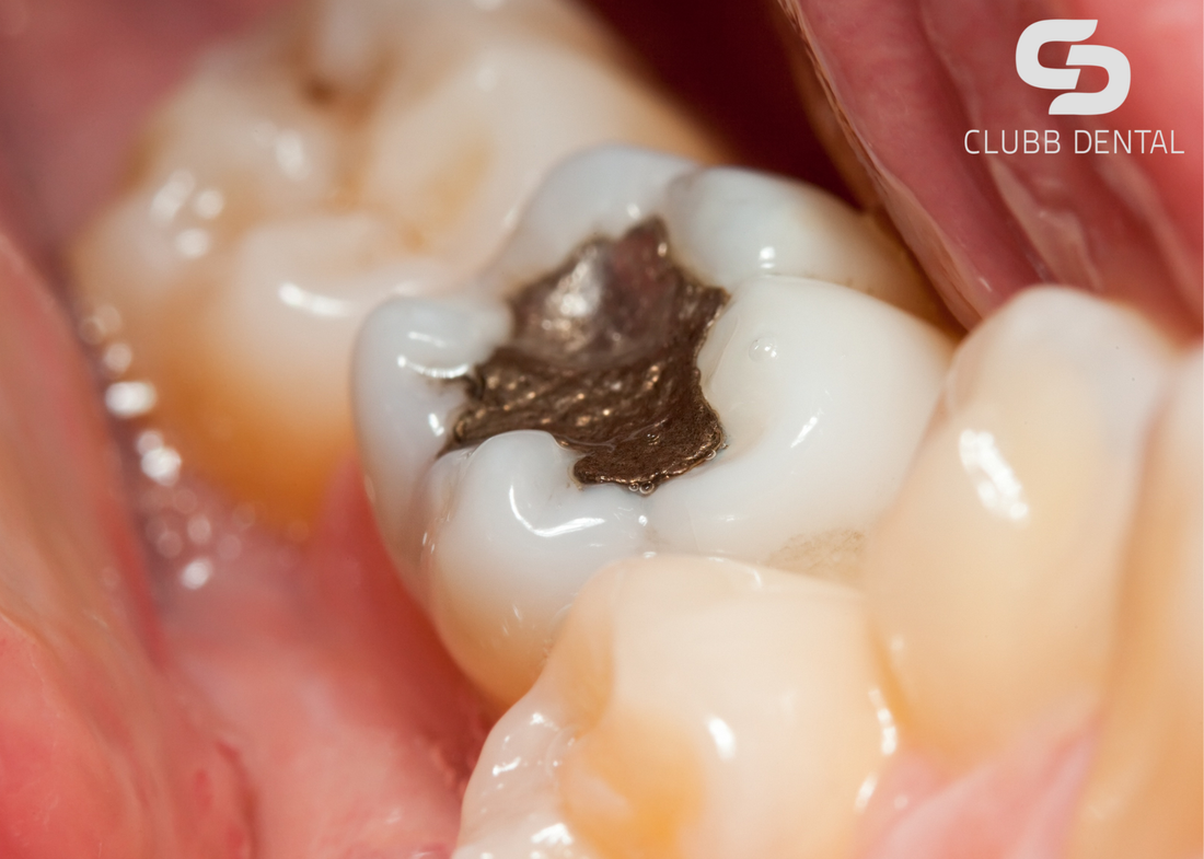 Clubb Dental Amalgam filling vs white filling