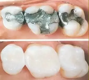 Types of dental fillings